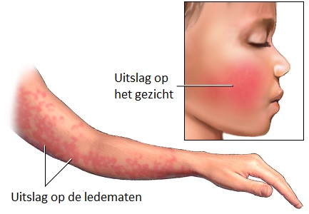 Vijfde ziekte altijd even melden!